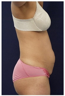 Tummy Tuck Before Photo by Michael Law, MD; Raleigh, NC - Case 33617