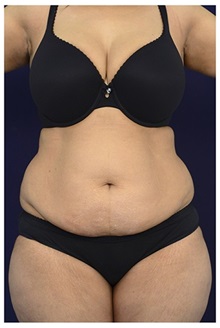 Tummy Tuck Before Photo by Michael Law, MD; Raleigh, NC - Case 33619