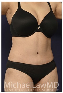 Tummy Tuck After Photo by Michael Law, MD; Raleigh, NC - Case 33619