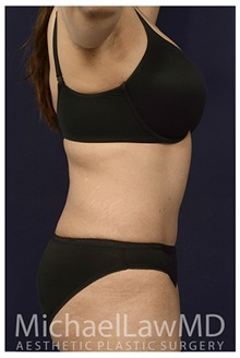 Tummy Tuck After Photo by Michael Law, MD; Raleigh, NC - Case 33619