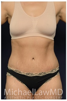 Tummy Tuck After Photo by Michael Law, MD; Raleigh, NC - Case 33620