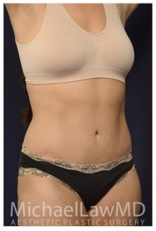 Tummy Tuck After Photo by Michael Law, MD; Raleigh, NC - Case 33620