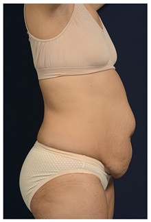 Tummy Tuck Before Photo by Michael Law, MD; Raleigh, NC - Case 33620