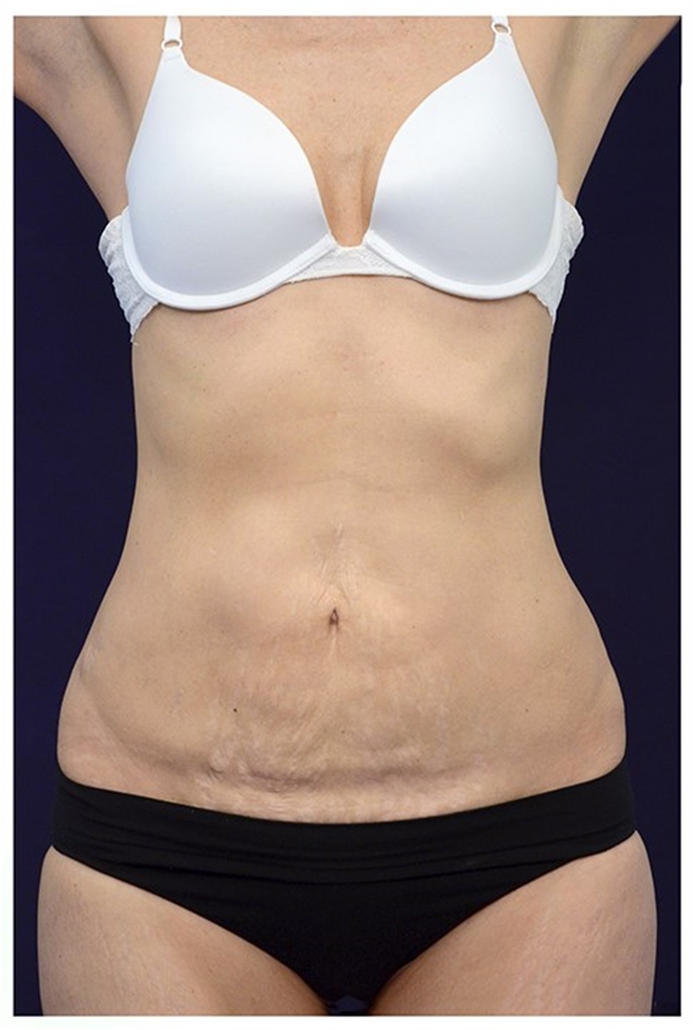 Tummy Tuck Before and After Photos by Michael Law, MD; Raleigh, NC