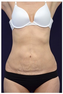 Tummy Tuck Before Photo by Michael Law, MD; Raleigh, NC - Case 33621