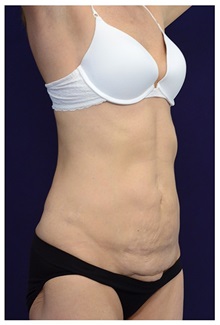 Tummy Tuck Before Photo by Michael Law, MD; Raleigh, NC - Case 33621