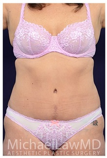 Tummy Tuck After Photo by Michael Law, MD; Raleigh, NC - Case 33672