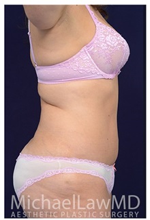 Tummy Tuck After Photo by Michael Law, MD; Raleigh, NC - Case 33672