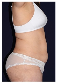 Tummy Tuck Before Photo by Michael Law, MD; Raleigh, NC - Case 33672