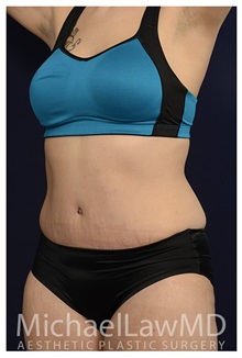 Tummy Tuck After Photo by Michael Law, MD; Raleigh, NC - Case 33673