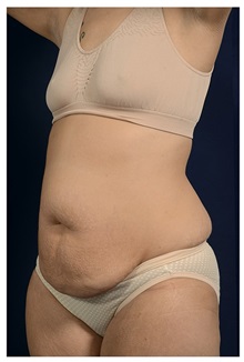 Tummy Tuck Before Photo by Michael Law, MD; Raleigh, NC - Case 33673