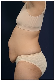Tummy Tuck Before Photo by Michael Law, MD; Raleigh, NC - Case 33673
