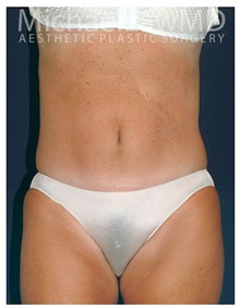 Tummy Tuck After Photo by Michael Law, MD; Raleigh, NC - Case 33674