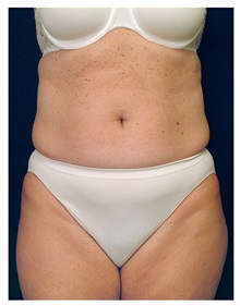 Tummy Tuck Before Photo by Michael Law, MD; Raleigh, NC - Case 33674