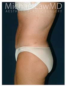Tummy Tuck After Photo by Michael Law, MD; Raleigh, NC - Case 33674
