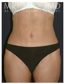 Tummy Tuck After Photo by Michael Law, MD; Raleigh, NC - Case 33675