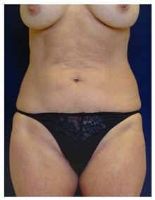 Tummy Tuck Before Photo by Michael Law, MD; Raleigh, NC - Case 33675