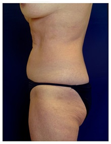 Tummy Tuck Before Photo by Michael Law, MD; Raleigh, NC - Case 33675