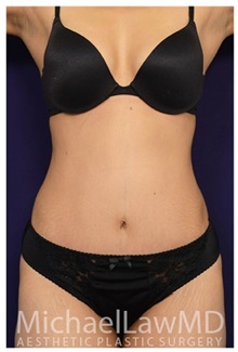 Tummy Tuck After Photo by Michael Law, MD; Raleigh, NC - Case 33676