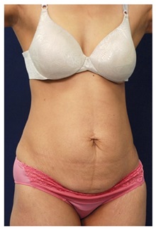 Tummy Tuck Before Photo by Michael Law, MD; Raleigh, NC - Case 33676