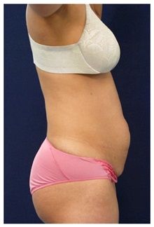 Tummy Tuck Before Photo by Michael Law, MD; Raleigh, NC - Case 33676