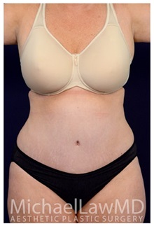 Tummy Tuck After Photo by Michael Law, MD; Raleigh, NC - Case 33677
