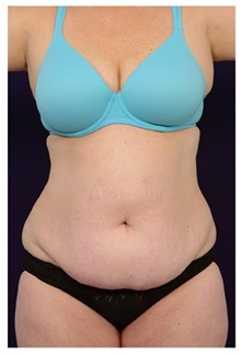Tummy Tuck Before Photo by Michael Law, MD; Raleigh, NC - Case 33677