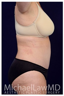 Tummy Tuck After Photo by Michael Law, MD; Raleigh, NC - Case 33677