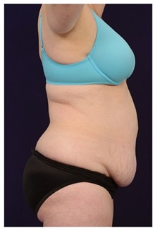 Tummy Tuck Before Photo by Michael Law, MD; Raleigh, NC - Case 33677