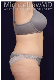 Tummy Tuck After Photo by Michael Law, MD; Raleigh, NC - Case 33678