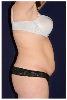 Tummy Tuck Before Photo by Michael Law, MD; Raleigh, NC - Case 33678