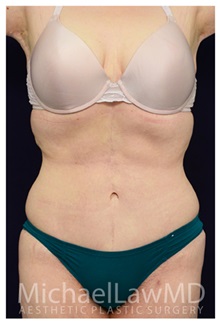 Tummy Tuck After Photo by Michael Law, MD; Raleigh, NC - Case 33679