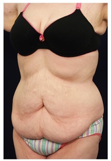Tummy Tuck Before Photo by Michael Law, MD; Raleigh, NC - Case 33679