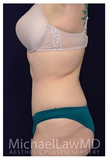 Tummy Tuck After Photo by Michael Law, MD; Raleigh, NC - Case 33679
