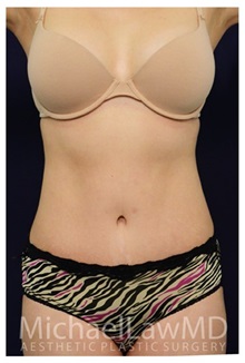 Tummy Tuck After Photo by Michael Law, MD; Raleigh, NC - Case 33681
