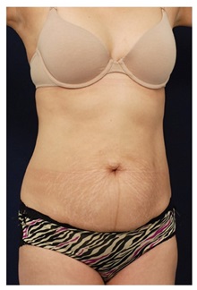 Tummy Tuck Before Photo by Michael Law, MD; Raleigh, NC - Case 33681