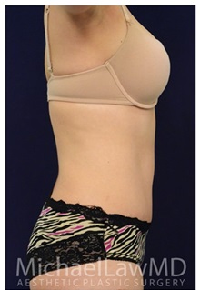 Tummy Tuck After Photo by Michael Law, MD; Raleigh, NC - Case 33681