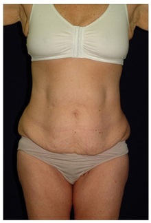 Tummy Tuck Before Photo by Michael Law, MD; Raleigh, NC - Case 33682