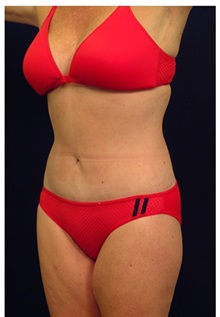 Tummy Tuck After Photo by Michael Law, MD; Raleigh, NC - Case 33682