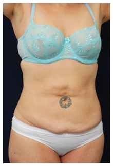 Tummy Tuck Before Photo by Michael Law, MD; Raleigh, NC - Case 33683