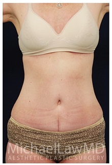 Tummy Tuck After Photo by Michael Law, MD; Raleigh, NC - Case 33684