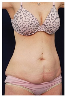Tummy Tuck Before Photo by Michael Law, MD; Raleigh, NC - Case 33684