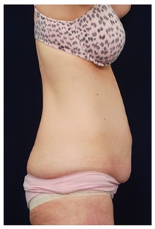 Tummy Tuck Before Photo by Michael Law, MD; Raleigh, NC - Case 33684