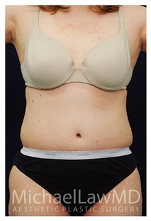 Tummy Tuck After Photo by Michael Law, MD; Raleigh, NC - Case 33685