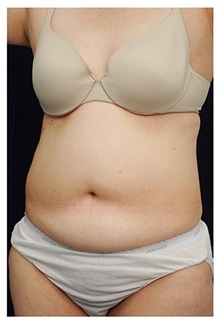 Tummy Tuck Before Photo by Michael Law, MD; Raleigh, NC - Case 33685
