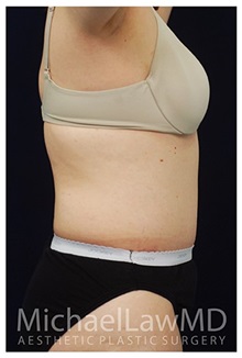 Tummy Tuck After Photo by Michael Law, MD; Raleigh, NC - Case 33685