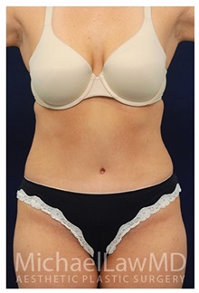 Tummy Tuck After Photo by Michael Law, MD; Raleigh, NC - Case 33689