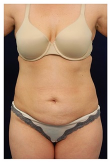Tummy Tuck Before Photo by Michael Law, MD; Raleigh, NC - Case 33689