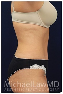 Tummy Tuck After Photo by Michael Law, MD; Raleigh, NC - Case 33689