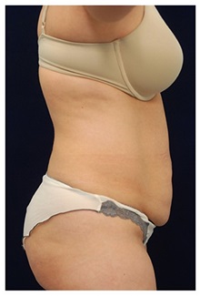 Tummy Tuck Before Photo by Michael Law, MD; Raleigh, NC - Case 33689